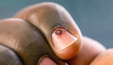 Tick Season: What to Know About Bites and Symptoms