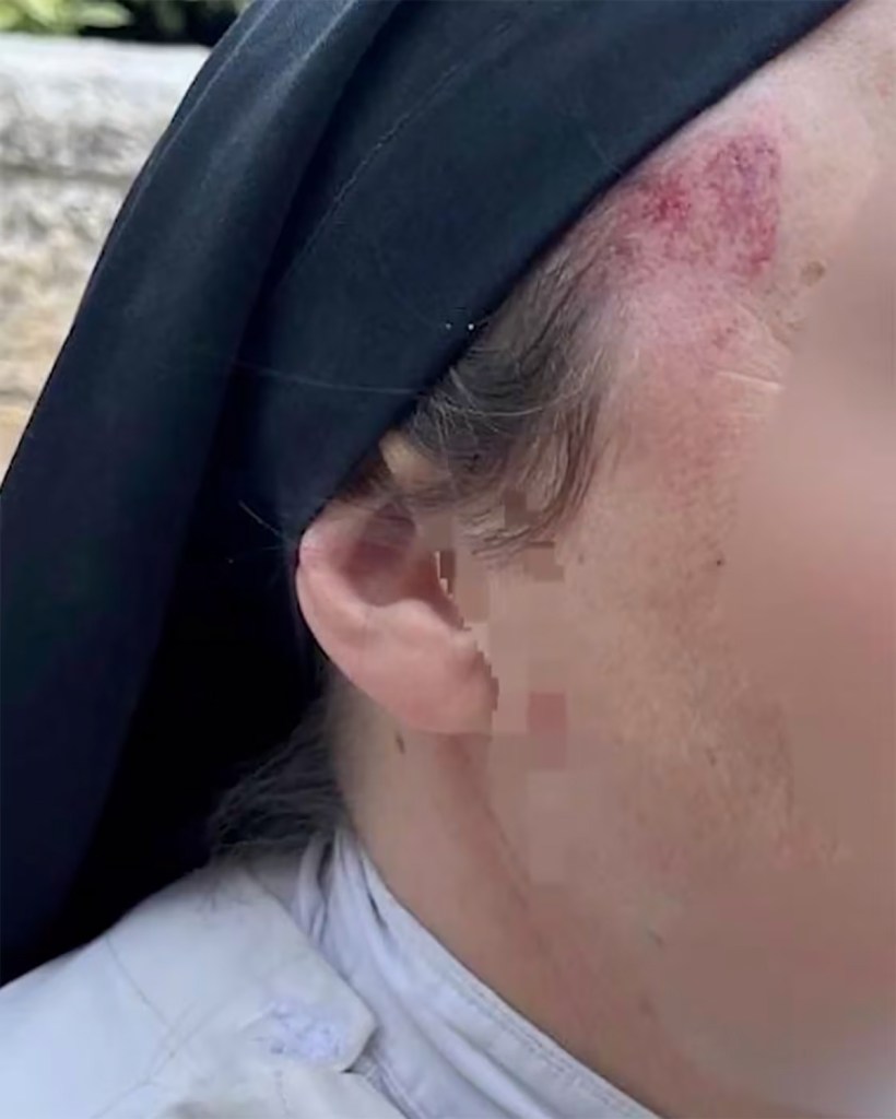 A nun with a scraped and bruised temple and forehead.