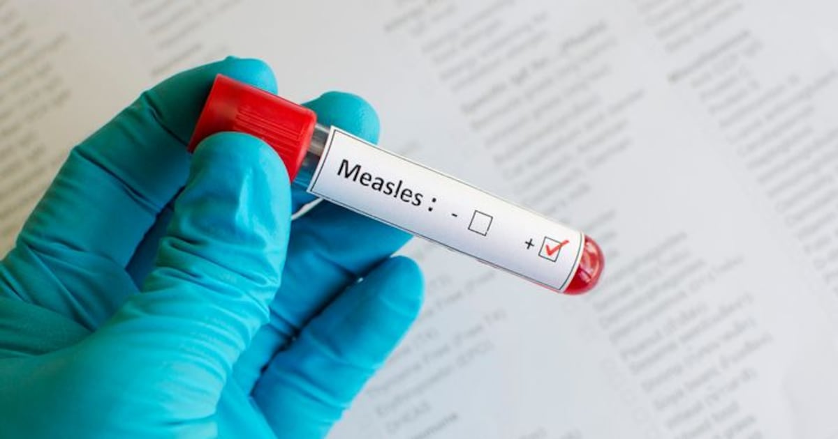 Measles in Peel: Exposure occurred at Pearson Airport, on 2 flights