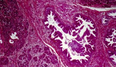 RevMed's pancreatic cancer, Akeso, Eli Lilly: Readout Newsletter