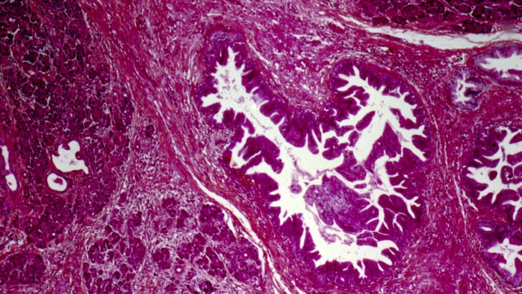 RevMed's pancreatic cancer, Akeso, Eli Lilly: Readout Newsletter