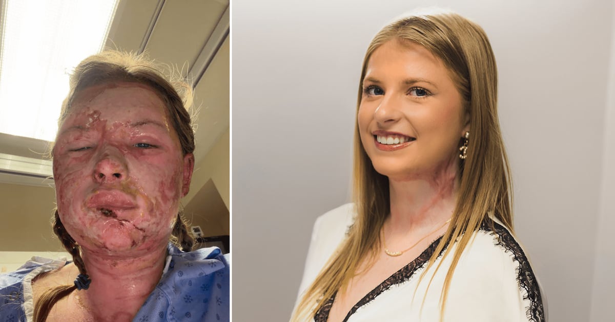 Hamilton doctors treat student burned in London frat house fire