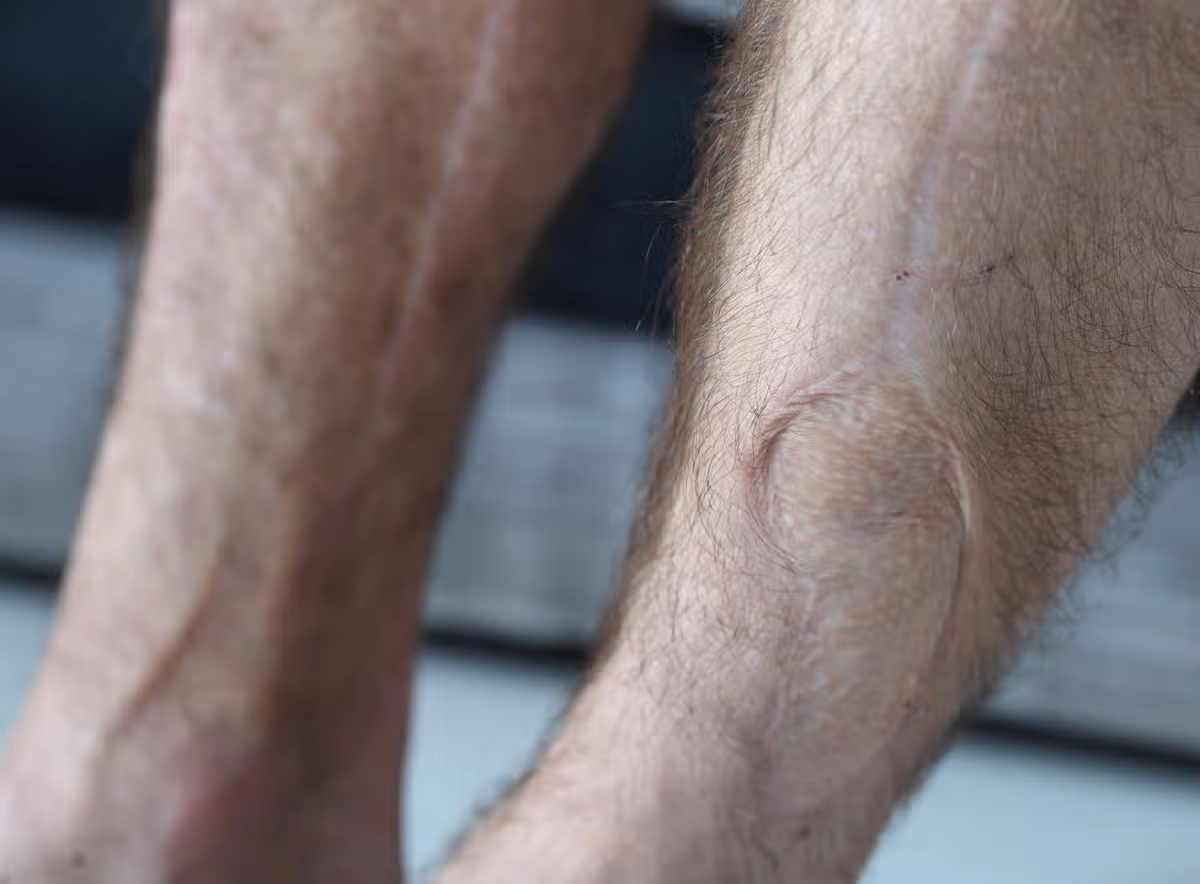 David Forbes' scars on his legs