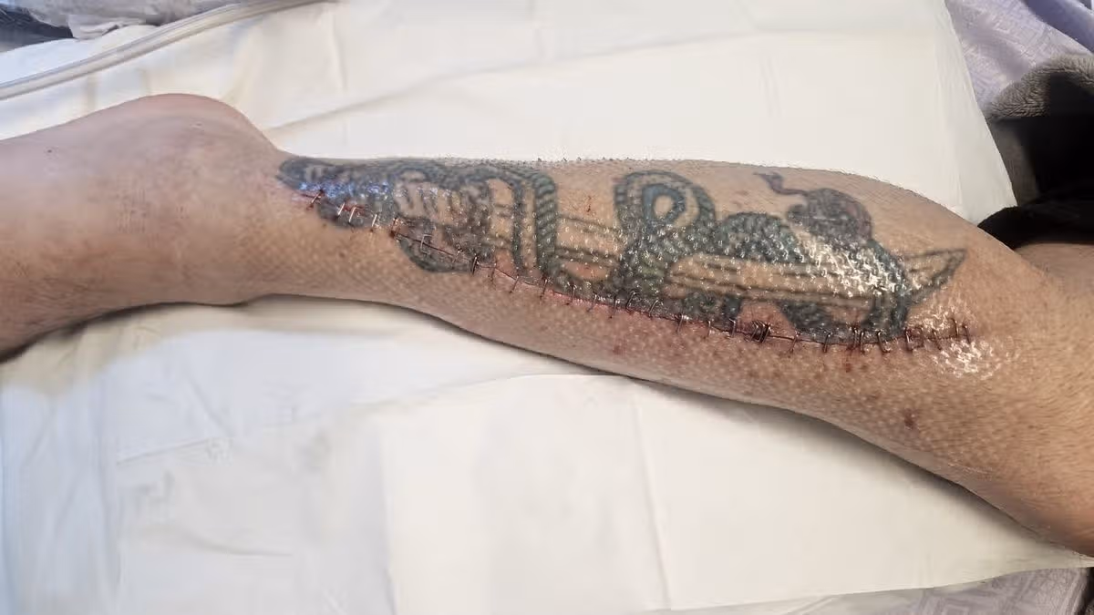 Davoid Forbes' lower right calf with a huge scar filled with staples. David Forbes was on his way to his local chippy in Croxteth, Liverpool, when he was shot in the legs by Daniel Lawless - a complete stranger who opened fire on him for no reason.