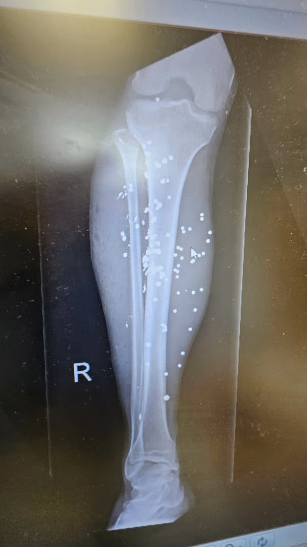 An x-ray of David Forbes' leg showing the pellets left embedded in him by Daniel Lawless' attack. David Forbes was on his way to his local chippy in Croxteth, Liverpool, when he was shot in the legs by Daniel Lawless - a complete stranger who opened fire on him for no reason.