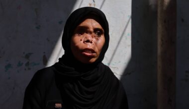 In Gaza, a long path to recovery for one woman who lost eye, and daughter | Israel-Palestine conflict News