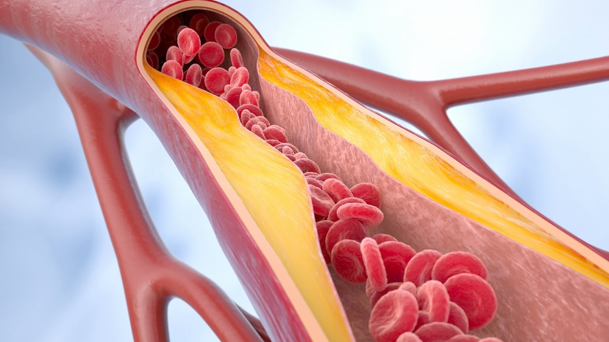 Cholesterol in arteries