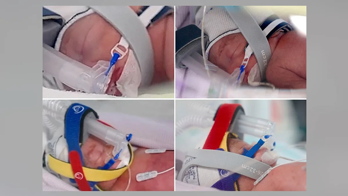 Woman becomes mom of 8 with birth of rare identical quadruplet daughters