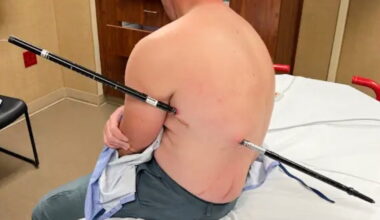 Montana man hikes himself to rescue with pole impaled in his side