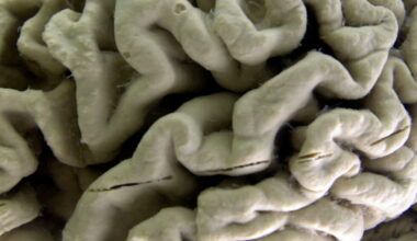 A blood test may predict the start of Alzheimer's symptoms years in advance