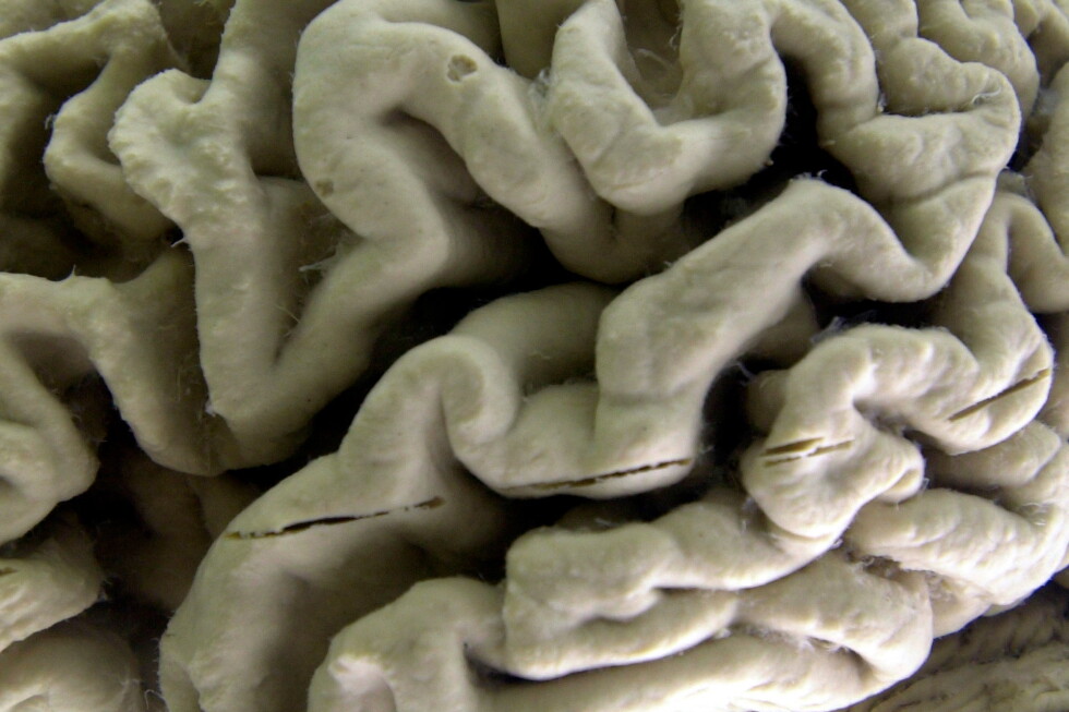 A blood test may predict the start of Alzheimer's symptoms years in advance