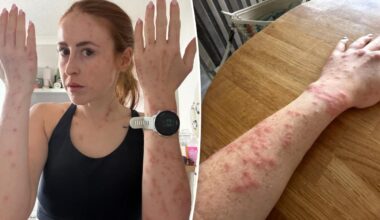 Hotel guest riddled with bedbug bites after Travelodge stay