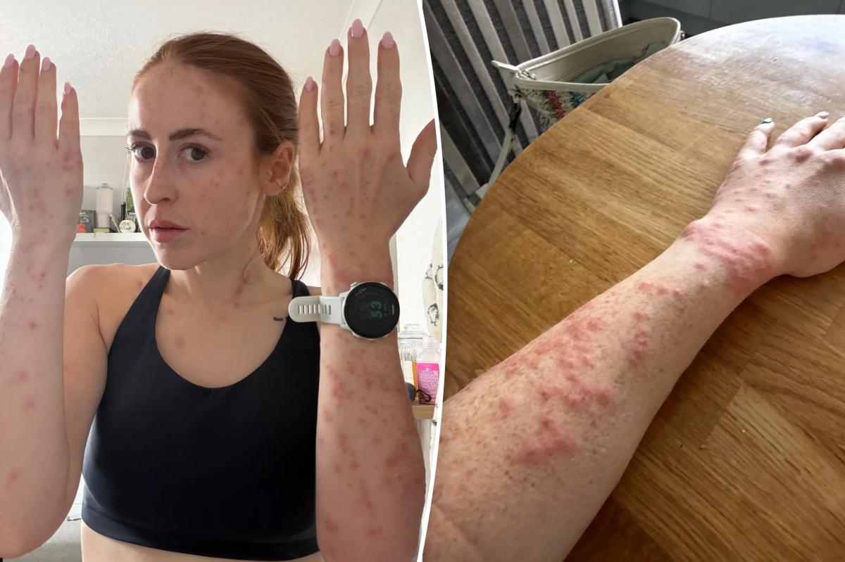 Hotel guest riddled with bedbug bites after Travelodge stay