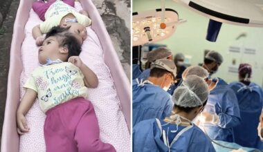 Conjoined twin girls, 2, die minutes after being separated following five grueling surgeries