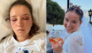 Bride gets severe allergic reaction to eyelash extensions before wedding