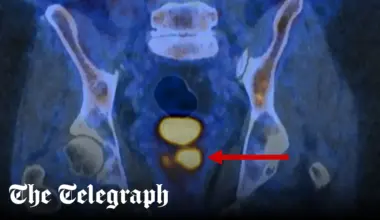 Men lose right to prostate cancer test