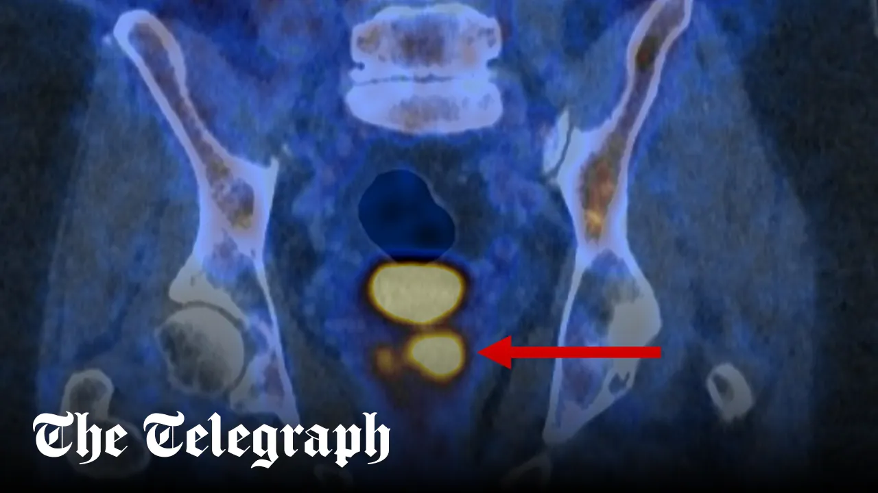 Men lose right to prostate cancer test