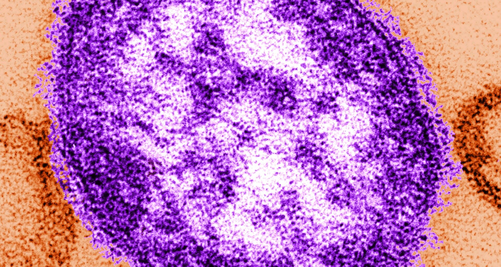 Measles in PA: 2 unvaccinated people die as outbreak grows