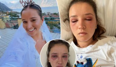 Bride-to-be sounds alarm after popular $88 beauty treatment left her almost blind before the big day