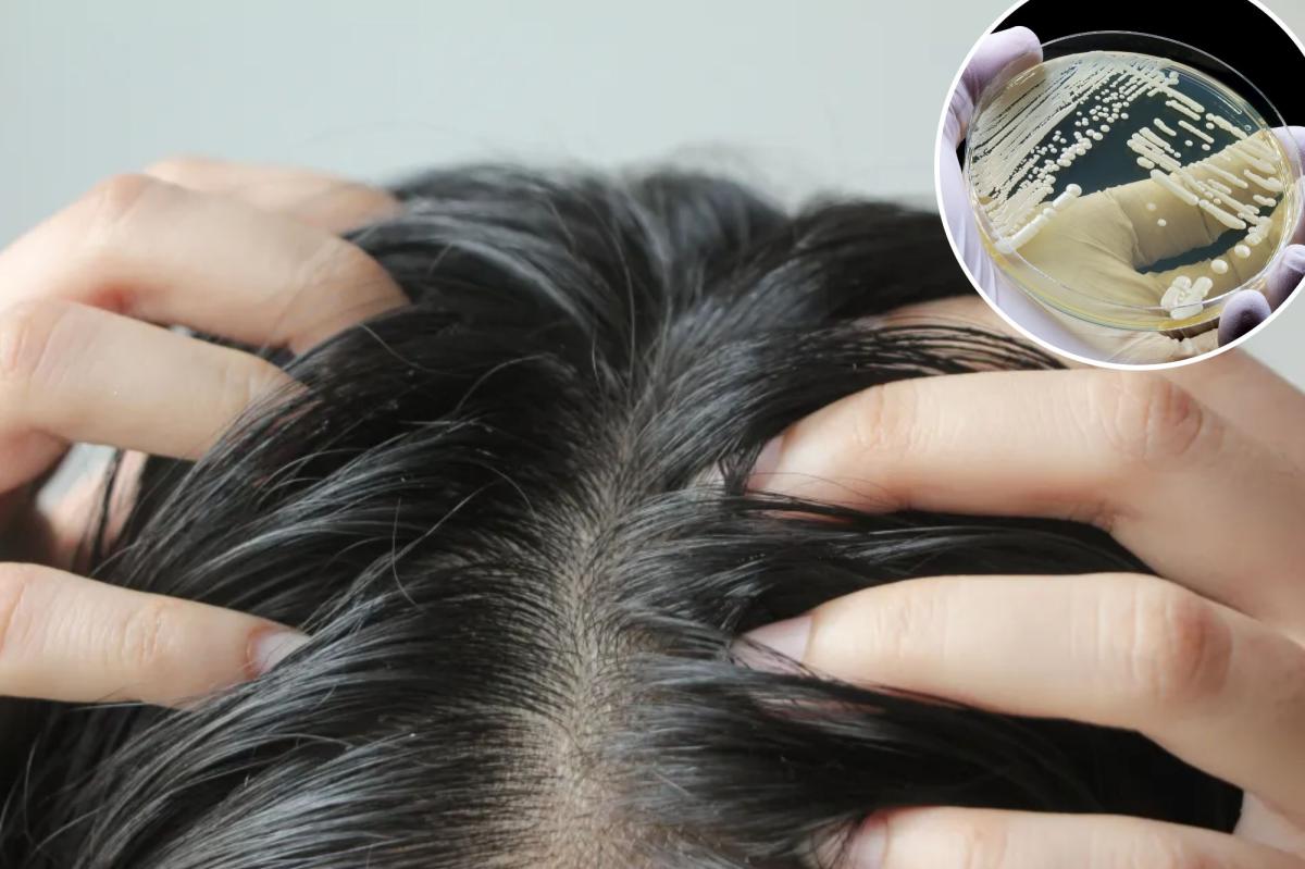 Deadly superbug confirmed in 23 states can hide in your hair