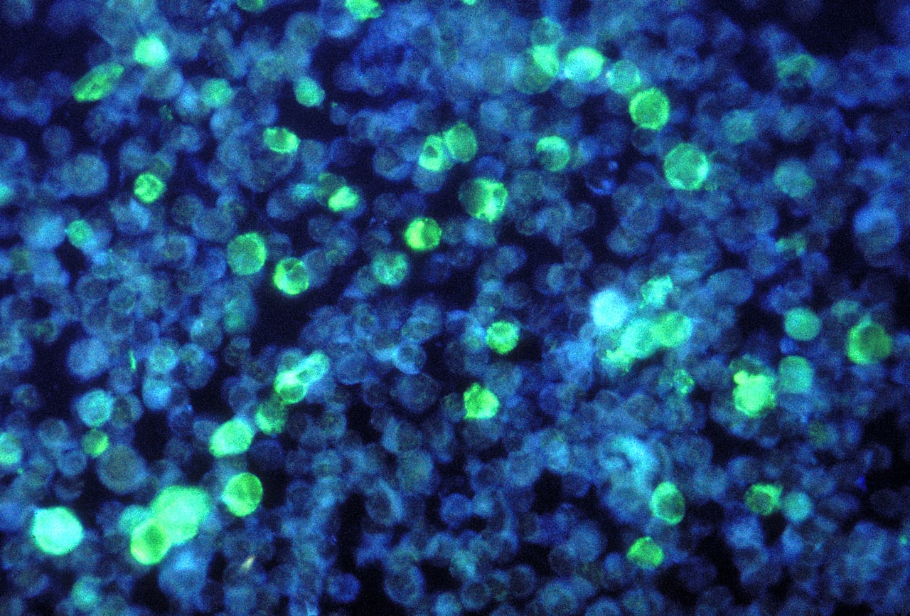 A photomicrograph shows leukemia cells, blue, that contain Epstein-Barr virus stained to glow green under ultraviolet light.