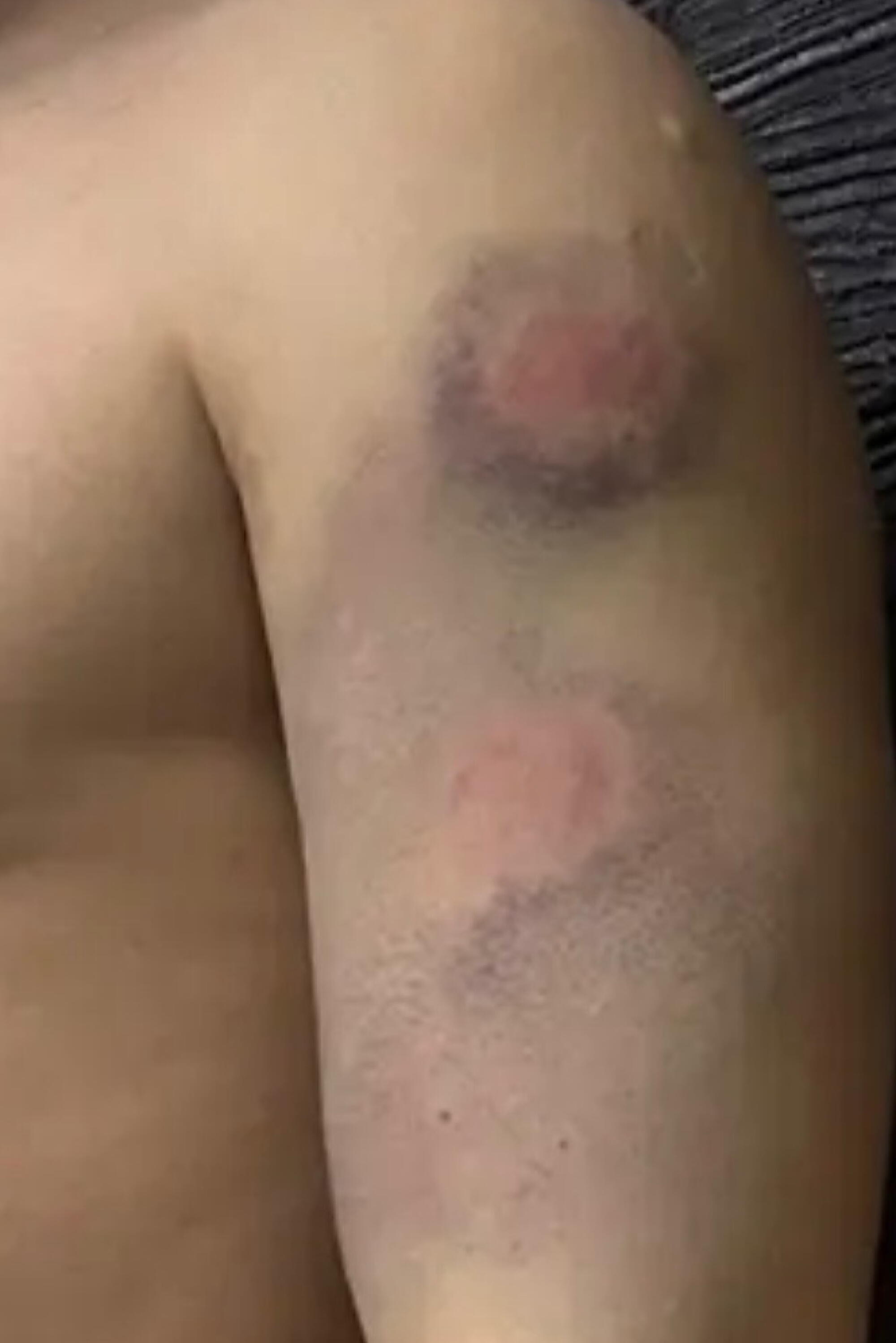 A round purple bruise with a red spot at the center on a man's upper arm 