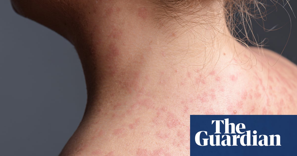 California warns of measles exposure in six counties from unvaccinated train passenger | California