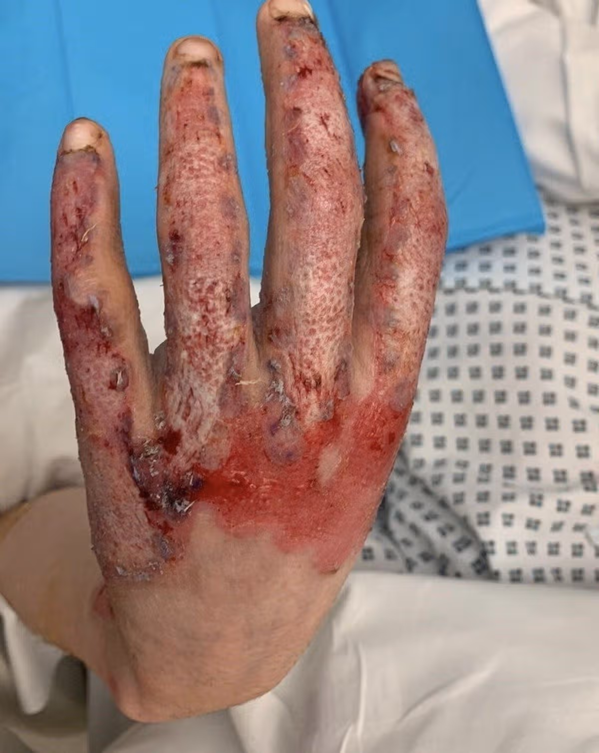 Dwayne's injured hands after the explosion