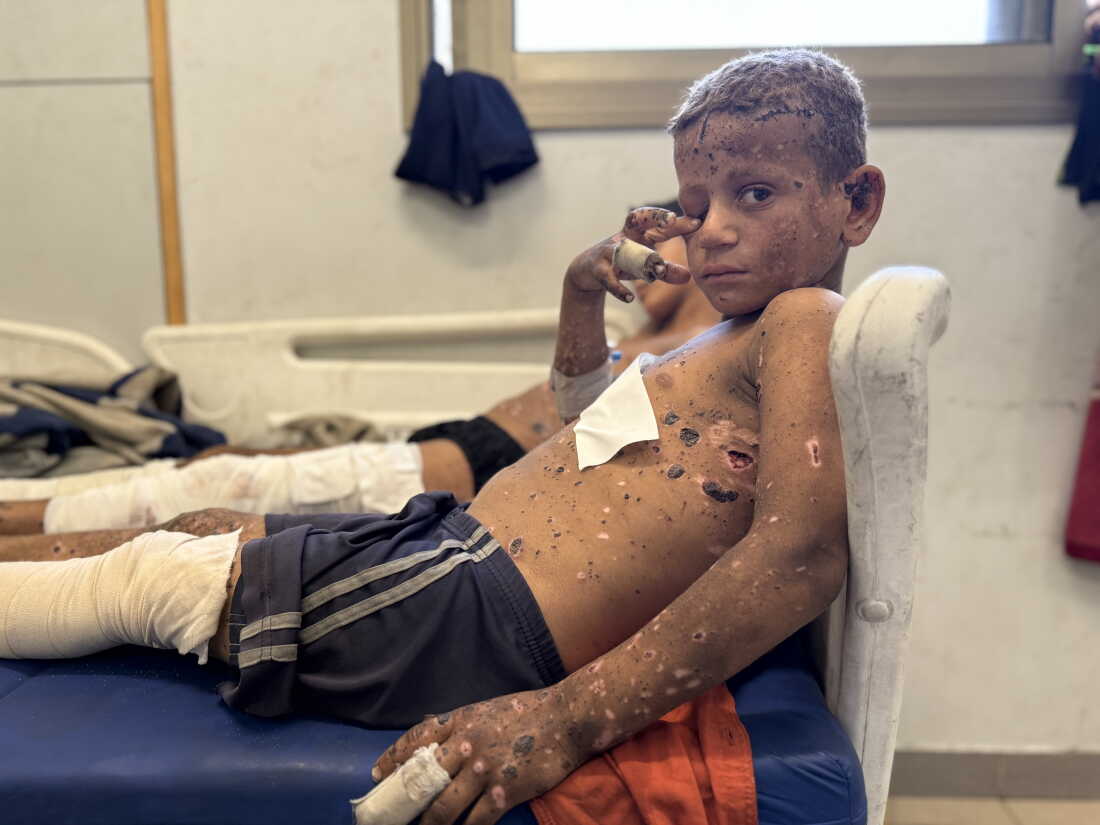 Zain Al-Angar, 12, reclines on a bed, with his younger cousin on a bed next to him. Zain is covered in dime-sized scabs on his face, torso and arms. One leg is covered in scabs, and the other is bandaged.
