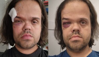 'In shock': Barrie council candidate brutally assaulted at bar