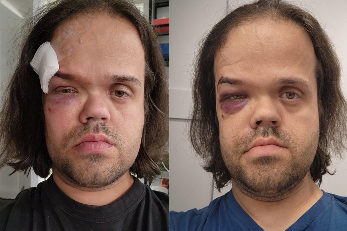 'In shock': Barrie council candidate brutally assaulted at bar