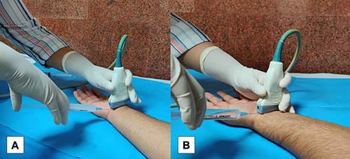 A Saline Injection Could Offer Longer Relief From Carpal Tunnel Pain